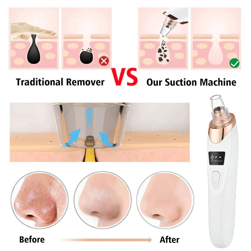 Electric Blackhead Acne Remover Vacuum Suction